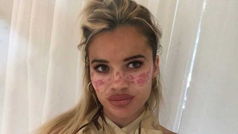 Essayez un soin du visage DIY vu sur TikTok et finissez à l'hôpital 1 Essayez un soin du visage DIY vu sur TikTok et finissez à l'hôpital