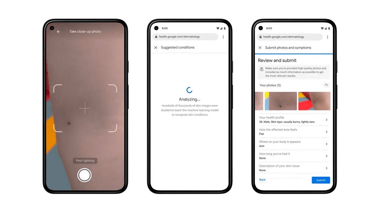 Cette application vous dira si vous avez un cancer de la peau 2 1621415006 755 Cette application vous dira si vous avez un cancer de