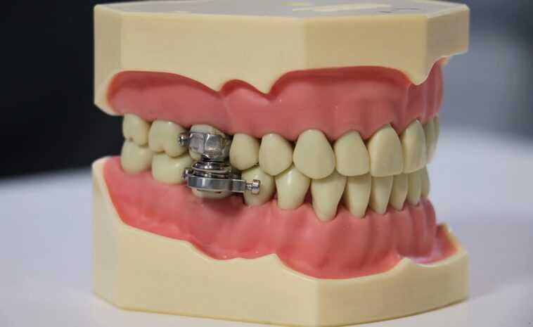 Luttant pour perdre du poids? Un nouvel appareil qui relie votre mâchoire pourrait vous aider 1 Struggling to lose weight? A new device that wires your jaw together could help