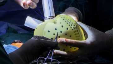 Comment fonctionne le cœur artificiel transplanté pour la première fois aux USA (et à Naples) 3 Comment Fonctionne Le Cœur Artificiel Transplanté Pour La Première Fois
