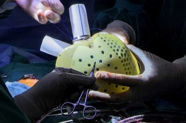 Comment fonctionne le cœur artificiel transplanté pour la première fois aux USA (et à Naples) 1 Comment Fonctionne Le Cœur Artificiel Transplanté Pour La Première Fois