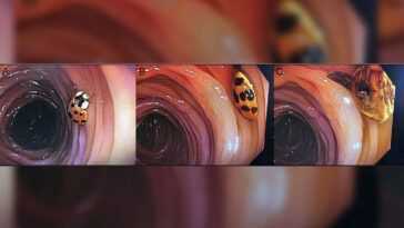 Des Médecins Découvrent Une Coccinelle Vivante Dans Les Intestins D'un
