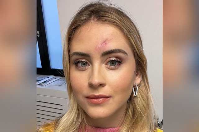 Qu'est-ce que le carcinome basocellulaire, la tumeur maligne de la peau qui a touché Valentina Ferragni 1 Qu'est Ce Que Le Carcinome Basocellulaire, La Tumeur Maligne De La