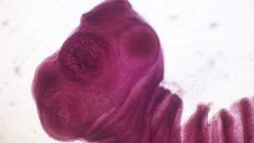 Un Homme A Découvert Qu'il Avait Un Ténia Qui Vivait