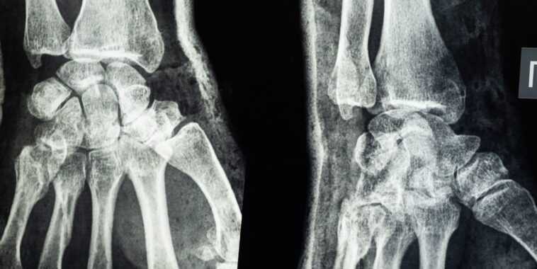 Un chirurgien français a tenté de vendre la radiographie d'une victime du Bataclan en tant que NFT 1 Un Chirurgien Français A Tenté De Vendre La Radiographie D'une