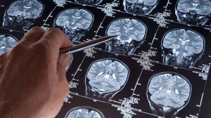 Ces emplois peuvent diminuer le risque de développer la maladie d'Alzheimer 3 Alzheimer