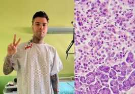 Quelle est la tumeur neuroendocrine rare du pancréas diagnostiquée à Fedez 73 Quelle Est La Tumeur Neuroendocrine Rare Du Pancréas Diagnostiquée à