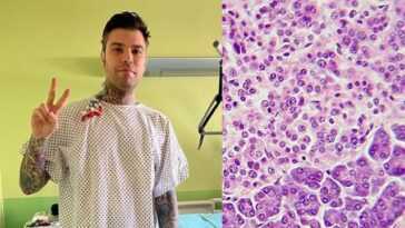 Quelle est la tumeur neuroendocrine rare du pancréas diagnostiquée à Fedez 30 Quelle Est La Tumeur Neuroendocrine Rare Du Pancréas Diagnostiquée à