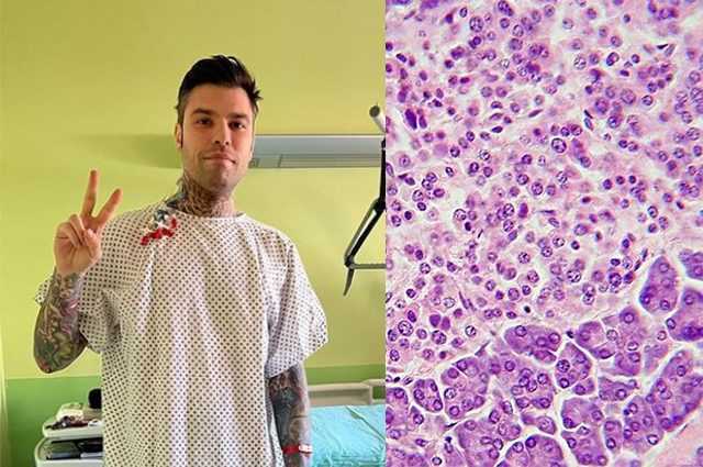 Quelle est la tumeur neuroendocrine rare du pancréas diagnostiquée à Fedez 1 Quelle Est La Tumeur Neuroendocrine Rare Du Pancréas Diagnostiquée à