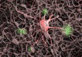 Découvert Quels Neurones Sont Tués Par La Maladie De Parkinson