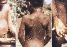 Nouveaux Cas De Monkeypox Au Royaume Uni, Sans Lien Avec Les