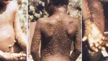 Nouveaux cas de monkeypox au Royaume-Uni, sans lien avec les voyages : "Événement rare et inhabituel" 4 Nouveaux Cas De Monkeypox Au Royaume Uni, Sans Lien Avec Les