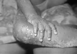 Qu'est Ce Que Le Monkeypox, La Maladie Transmissible Humaine Découverte Au