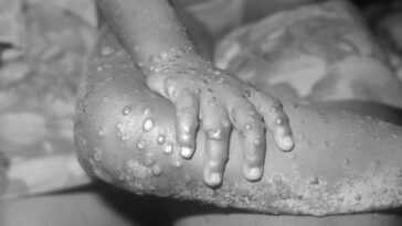Qu'est-ce que le monkeypox, la maladie transmissible humaine découverte au Royaume-Uni: symptômes et causes 1 Qu'est Ce Que Le Monkeypox, La Maladie Transmissible Humaine Découverte Au