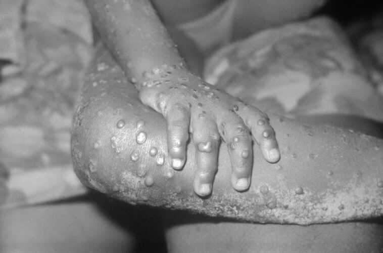 Qu'est-ce que le monkeypox, la maladie transmissible humaine découverte au Royaume-Uni: symptômes et causes 1 Qu'est Ce Que Le Monkeypox, La Maladie Transmissible Humaine Découverte Au