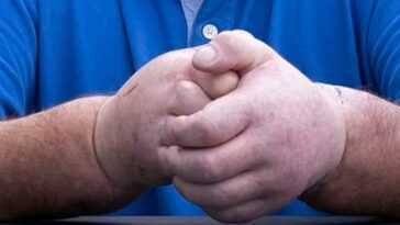 Un Homme Atteint De Sclérodermie A Reçu Sa Première Greffe