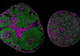 Une Mutation Génétique Dans L'autisme Peut être Inversée Grâce à