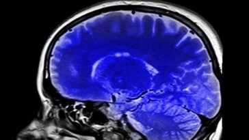 Une thérapie possible pour le glioblastome, le cancer du cerveau malin le plus courant et le plus mortel, découverte 14 Une Thérapie Possible Pour Le Glioblastome, Le Cancer Du Cerveau