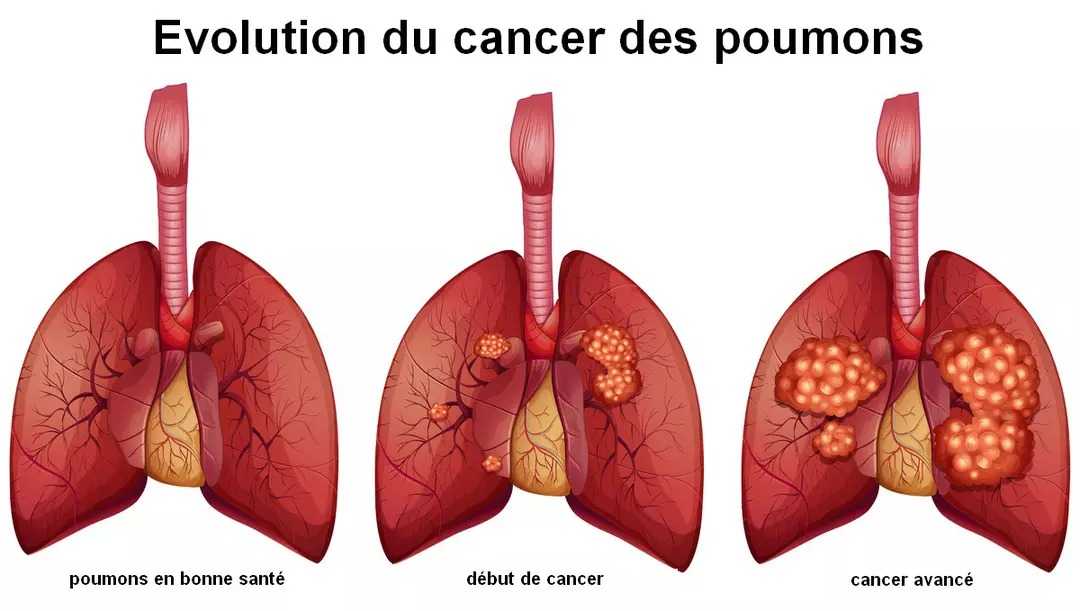 Pourquoi de nombreux fumeurs n'attrapent pas le cancer du poumon : un secret possible révélé 2 Evolution Cancer Poumon