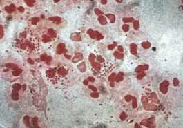 Découverte D'une Souche De "super Gonorrhée" Résistante Aux Antibiotiques :