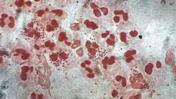 Découverte d'une souche de "super gonorrhée" résistante aux antibiotiques : un Autrichien infecté 8 Découverte D'une Souche De "super Gonorrhée" Résistante Aux Antibiotiques :