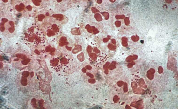 Découverte d'une souche de "super gonorrhée" résistante aux antibiotiques : un Autrichien infecté 1 Découverte D'une Souche De "super Gonorrhée" Résistante Aux Antibiotiques :
