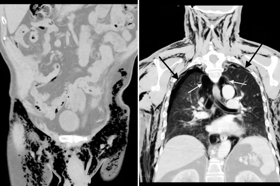 Un homme s'est retrouvé à l'hôpital parce que son scrotum s'est mis à siffler 3 Une radiographie pulmonaire de l'homme a montré une accumulation d'air dans le corps / American Journal of Case Reports