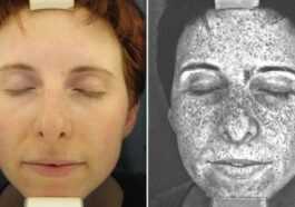 Ces Images Montrent Les Dommages Cutanés Causés Par Le Soleil