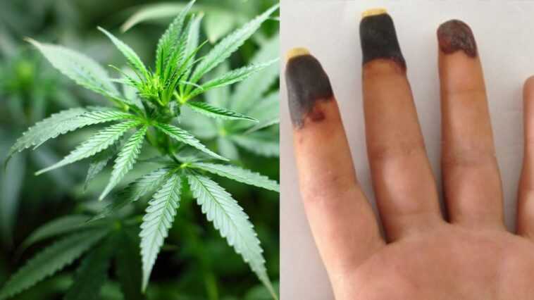 Un consommateur de cannabis développe des doigts bleus et des lésions douloureuses - l'effet secondaire rare 1 Un Consommateur De Cannabis Développe Des Doigts Bleus Et Des
