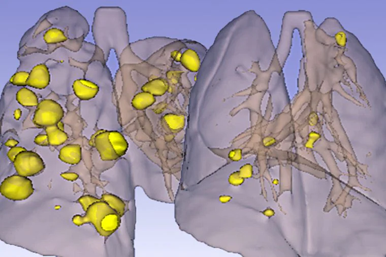 Une thérapie expérimentale bloque une forme mortelle de cancer du poumon lors de tests en laboratoire 2 Cette tomodensitométrie montre la réduction (à droite) du cancer du poumon après un traitement avec les deux médicaments. Crédit : Simone Hausmann et Pawel Mazur
