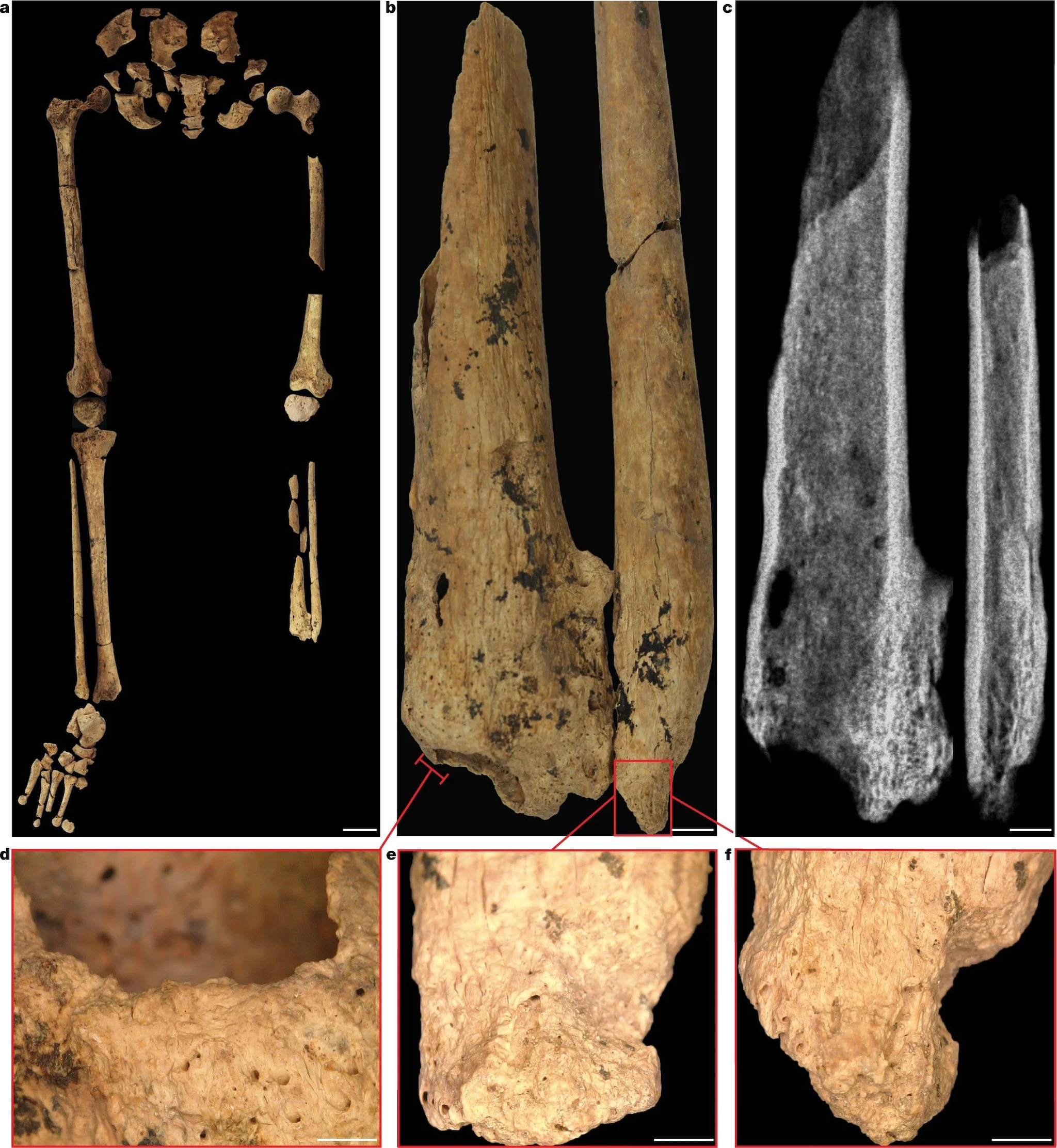La plus ancienne amputation chirurgicale a été réalisée il y a 31 000 ans : l'histoire de la médecine a été réécrite 4 Crédit : Nature