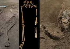 La Plus Ancienne Amputation Chirurgicale A été Réalisée Il Y
