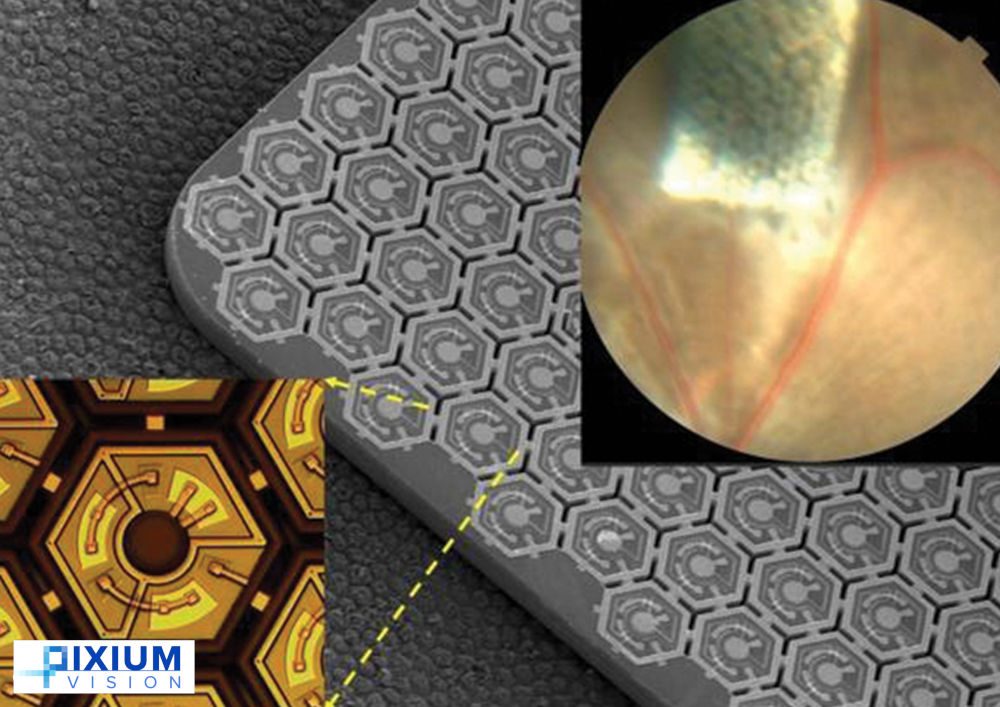 Une rétine artificielle implantée à Nice qui donne une vision bionique aux patients aveugles à cause d'une maculopathie 5 Crédit : Pixium Vision