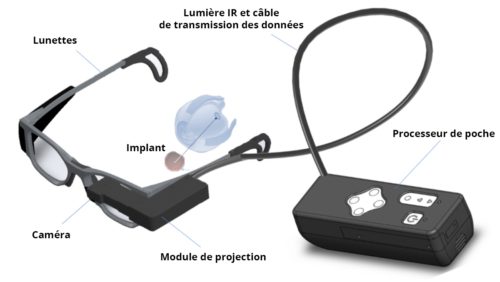 Une rétine artificielle implantée à Nice qui donne une vision bionique aux patients aveugles à cause d'une maculopathie 4 Crédit : Pixium Vision