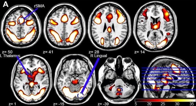 Les zones cérébrales activées par les jeux vidéo / Neuroimage : Reportages.