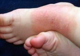 Dermatite atopique, les anticorps monoclonaux réduisent les démangeaisons et 75% des signes d'eczéma chez les enfants 1 Dermatite Atopique, Les Anticorps Monoclonaux Réduisent Les Démangeaisons Et 75%