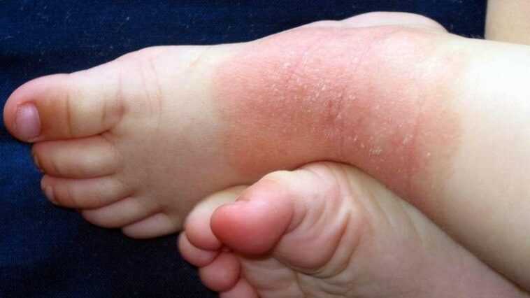Dermatite atopique, les anticorps monoclonaux réduisent les démangeaisons et 75% des signes d'eczéma chez les enfants 1 Dermatite Atopique, Les Anticorps Monoclonaux Réduisent Les Démangeaisons Et 75%