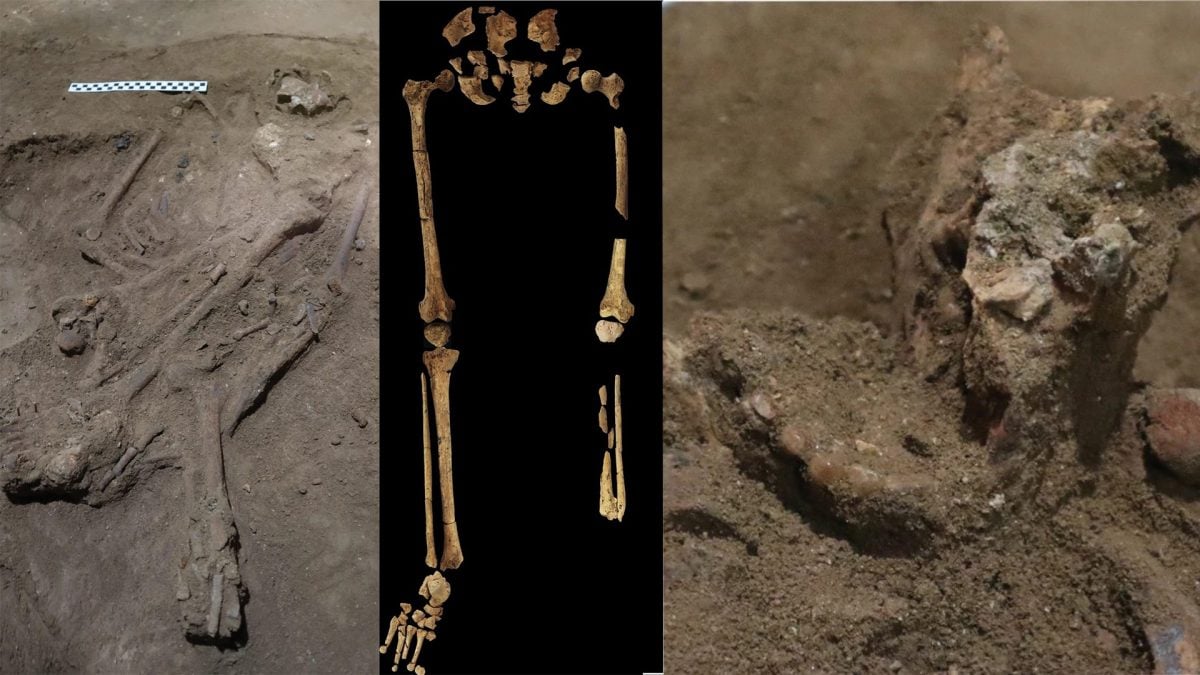 La plus ancienne amputation chirurgicale a été réalisée il y a 31 000 ans : l'histoire de la médecine a été réécrite 2 Crédit : Nature