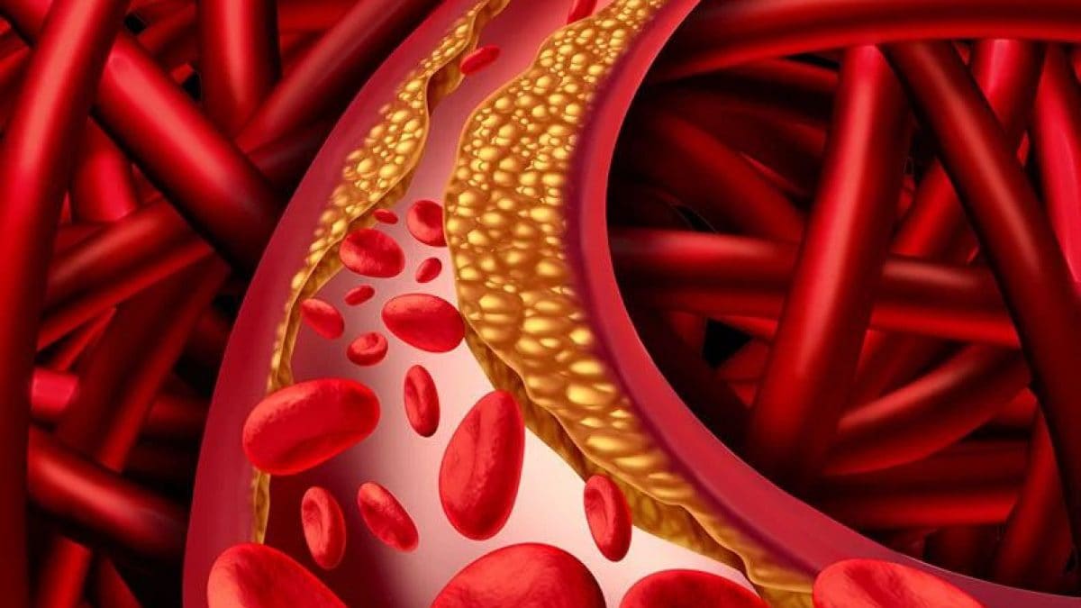 Nouveau vaccin réduit le taux de cholestérol élevé de 30% en laboratoire : coûte moins cher que les médicaments 2 Quest ce que lincisiran et comment ca marche le nouveau medicament