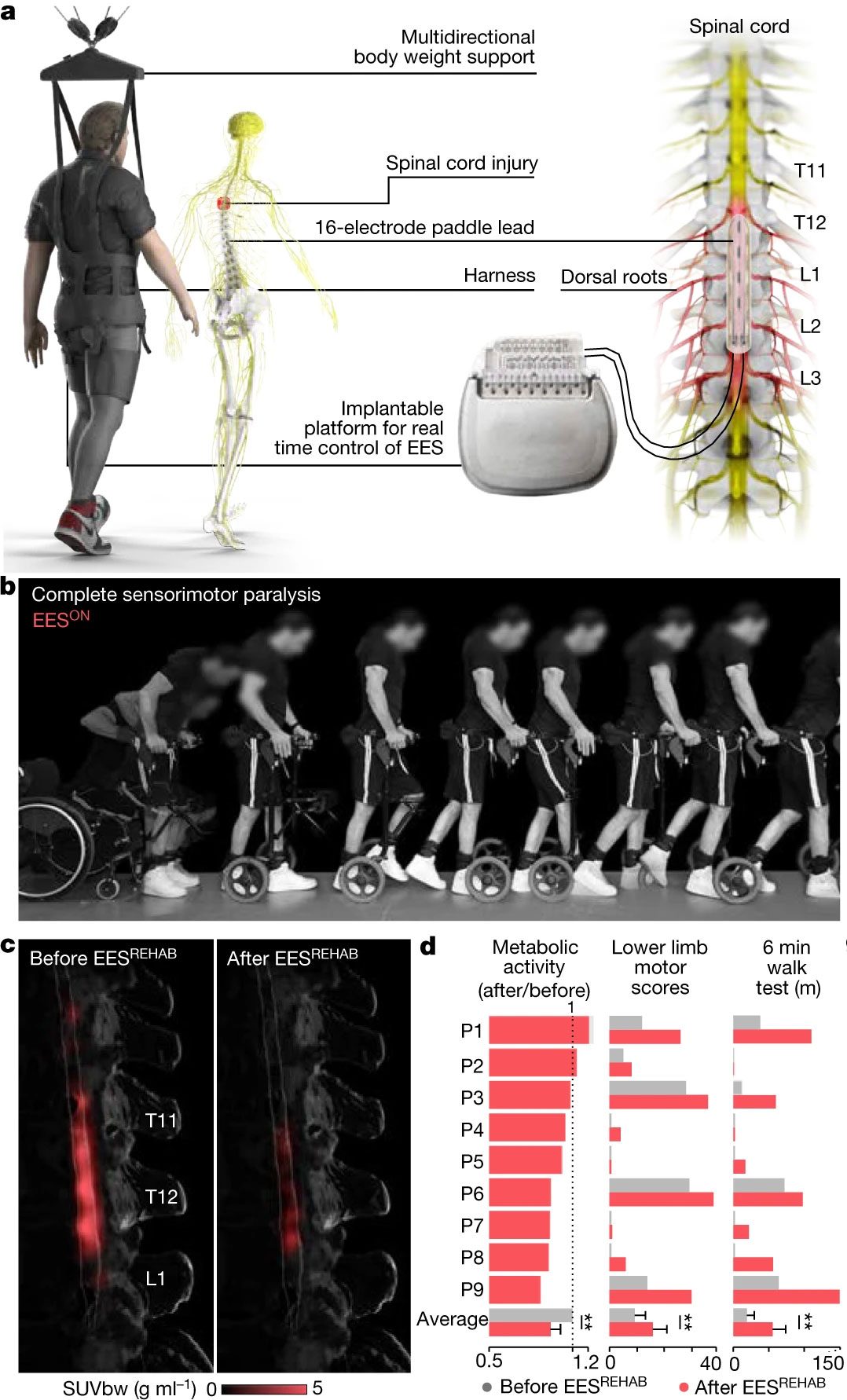 Une thérapie innovante contre la paralysie permet à neuf personnes de remarcher 3 Le système de support du poids corporel qui permet la marche en surface et un générateur d'impulsions implantable EES / Nature