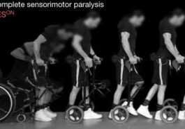 Une Thérapie Innovante Contre La Paralysie Permet à Neuf Personnes