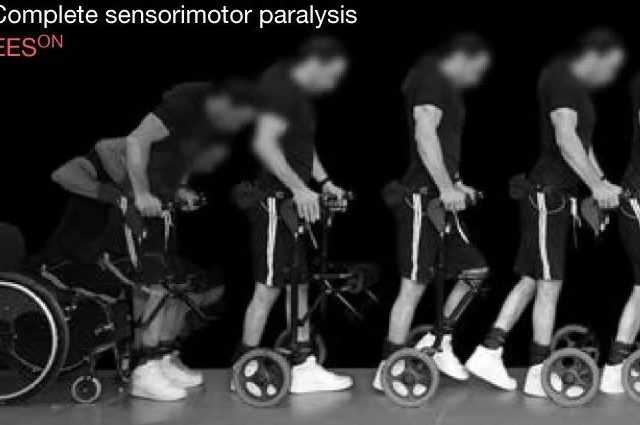 Une thérapie innovante contre la paralysie permet à neuf personnes de remarcher 1 Une Thérapie Innovante Contre La Paralysie Permet à Neuf Personnes
