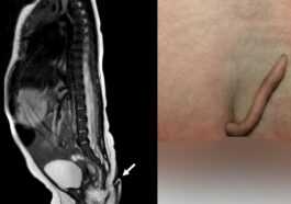 Bébé Fille Née Avec Une Queue De 6 Cm Recouverte