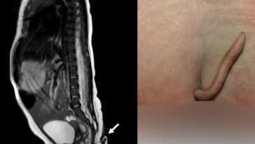 Bébé fille née avec une queue de 6 cm recouverte de poils : "Événement très rare" 14 Bébé Fille Née Avec Une Queue De 6 Cm Recouverte