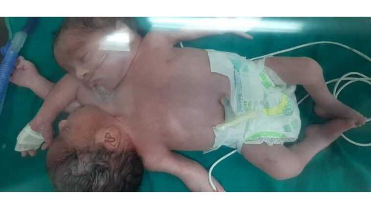 Jumeaux siamois nés joints par la poitrine et l'abdomen : ils ont quatre bras et deux jambes 1 Jumeaux Siamois Nés Joints Par La Poitrine Et L'abdomen :