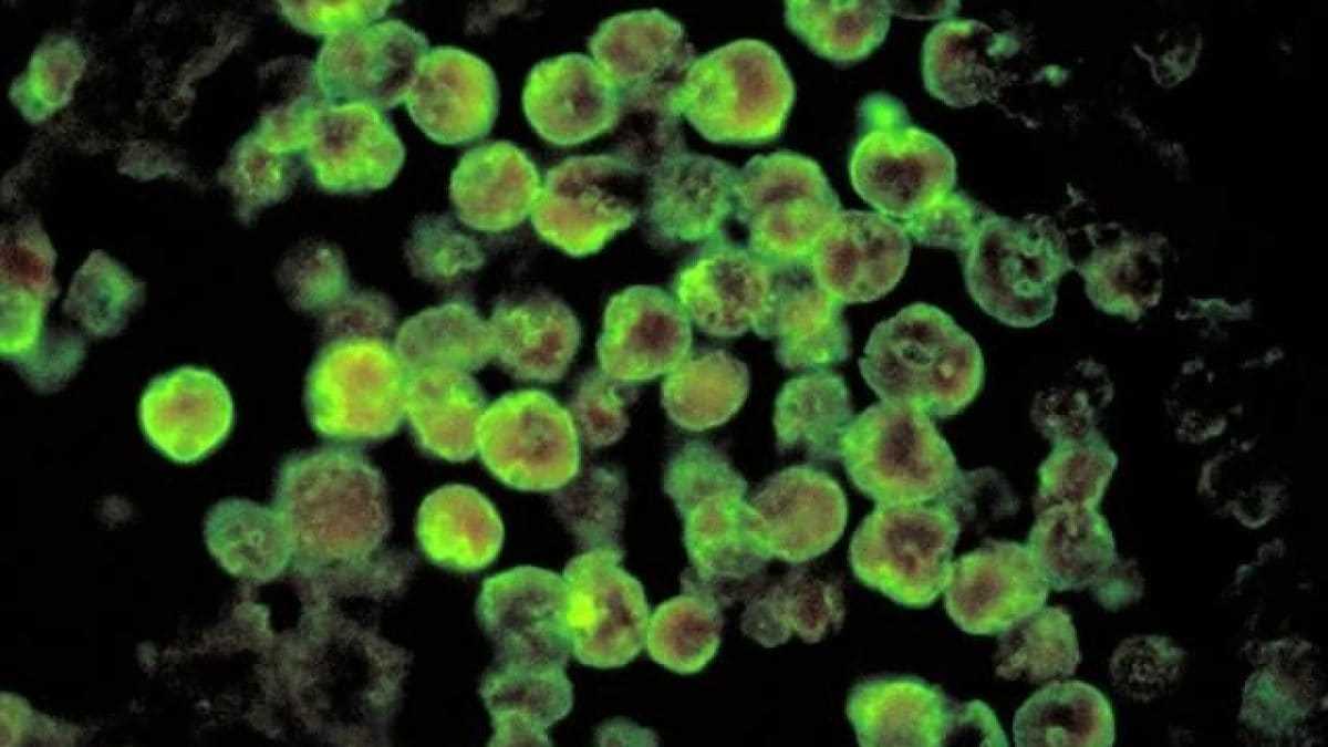 Premier Cas Mortel D'amibe Mangeuse De Cerveau En Corée Du