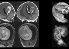 Jumeau "parasite" extrait du cerveau d'une fillette d'un an : le cas du Fœtus chez le fœtus