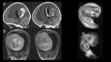 Jumeau "parasite" extrait du cerveau d'une fillette d'un an : le cas du Fœtus chez le fœtus