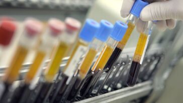 Les niveaux de sucre dans le sang peuvent prédire le risque d'Alzheimer 7 Les niveaux de sucre dans le sang peuvent prédire le risque d'Alzheimer