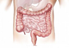 Cos’è il tumore del colon: quali sono i sintomi e le cause